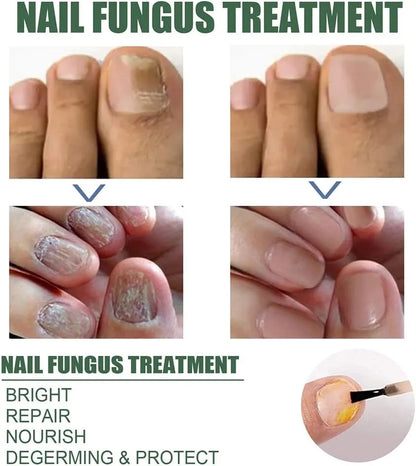 【Officiële Merkwinkel】 BESTE NAGELHERSTEL, STOP SCHIMMELGROEI